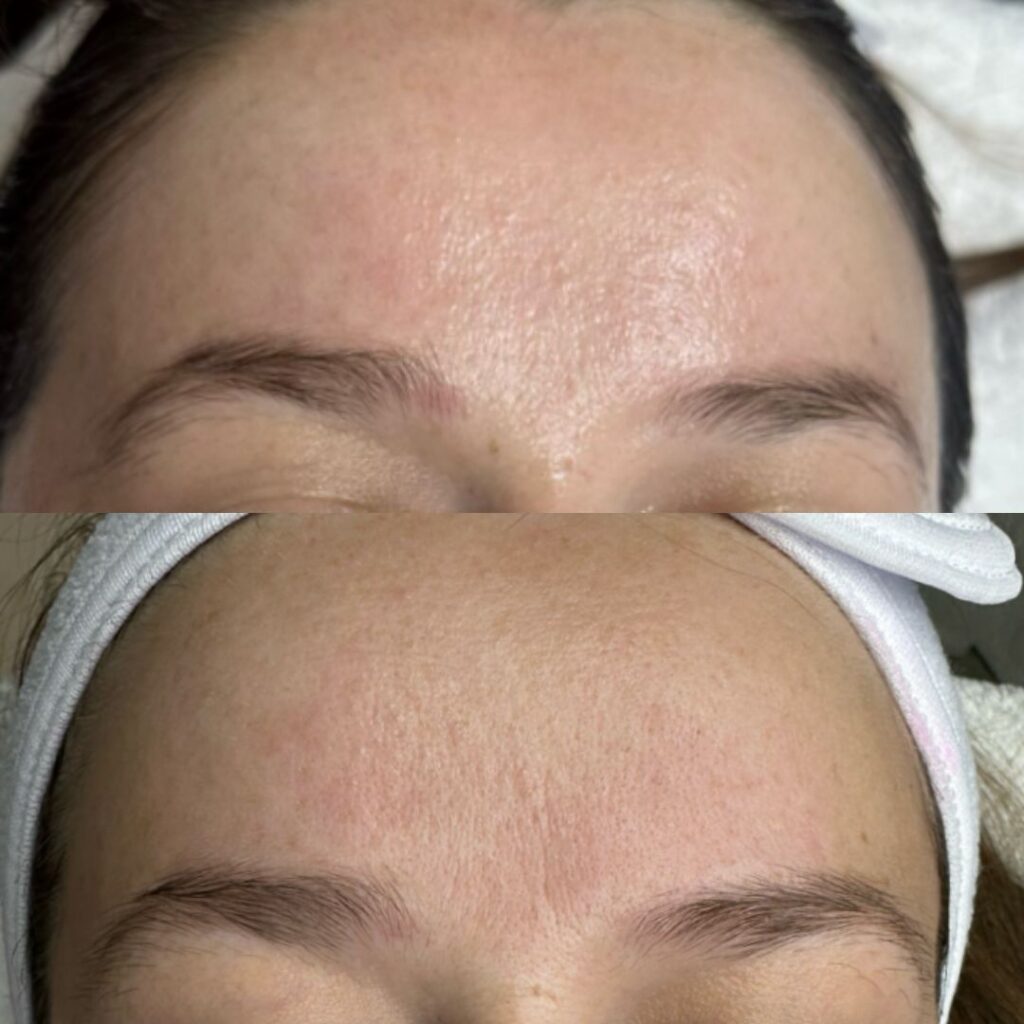 טיפול באקנה ואדמומיות בעור הפנים בקליניקה קוסמטית