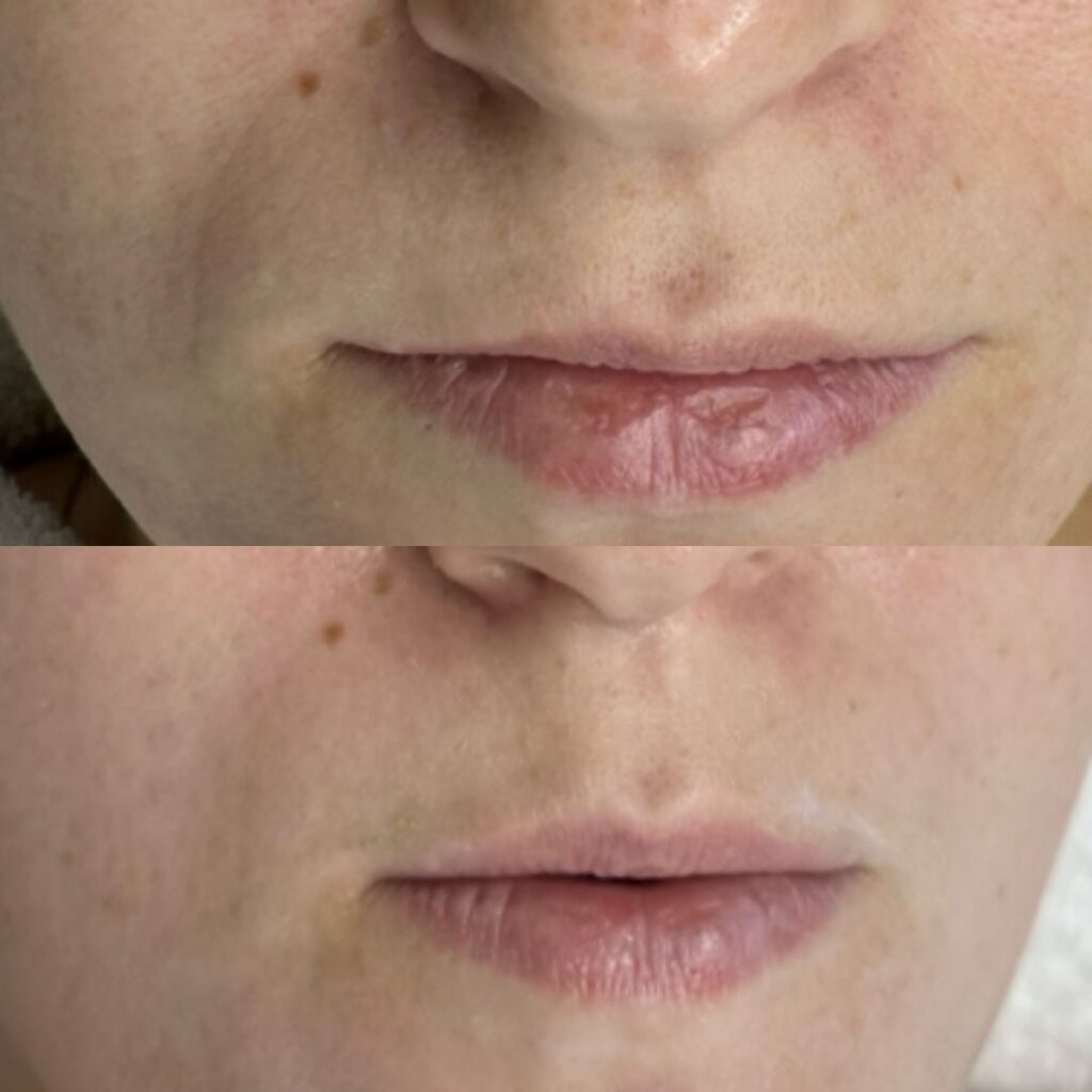 תוצאות של טיפול פנים מקצועי לשיפור מרקם העור