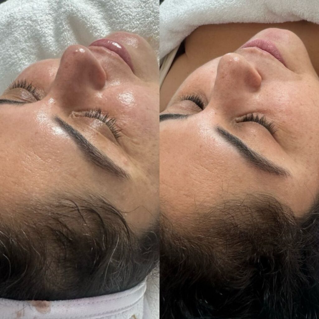 טיפול עור מתקדם לשיפור מראה המצח